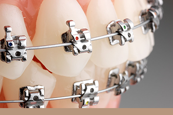 BClinic - Dental Clinic - Services - Self Ligating Braces 