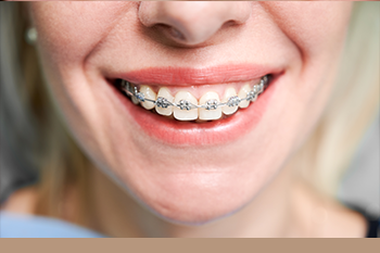 BClinic - Dental Clinic - Services - Metal Braces