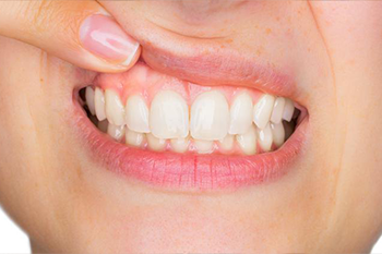 BClinic - Dental Clinic - Services - Gum Disease