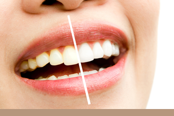 BClinic - Dental Clinic - Services - Teeth Whitening