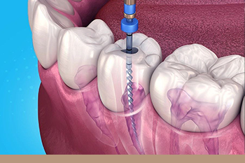 BClinic - Dental Clinic - Services - Procedure For Getting Microscopic Root Canal Treatment