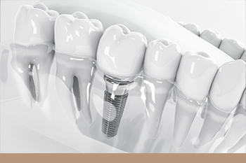 BClinic - Dental Clinic - Services - Procedure For Getting Dental Implants