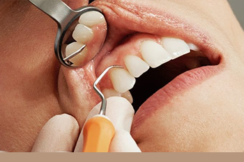 BClinic - Dental Clinic - Services - Gum Recession Treatment