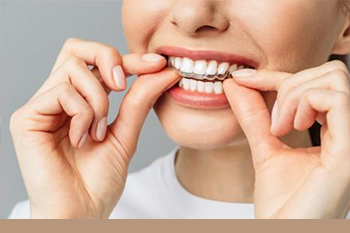 BClinic - Dental Clinic - Services - Invisalign