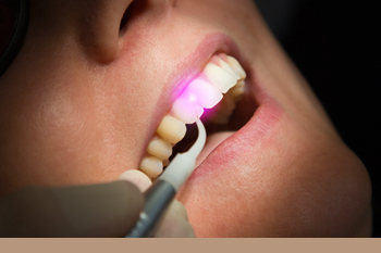 BClinic - Dental Clinic - Services - Aesthetic Gum Correction 
