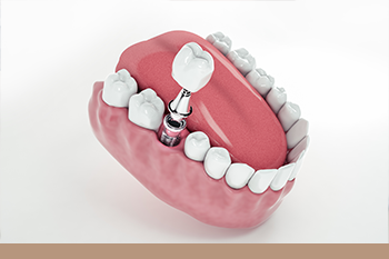 BClinic - Dental Clinic - Services - 3D Guided Dental Implant Surgery 