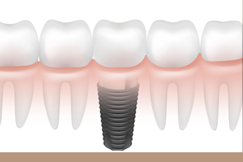 BClinic - Dental Clinic - Services - All-On-4 Dental Implants