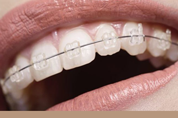 BClinic - Dental Clinic - Services - Ceramic Braces