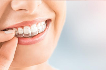 BClinic - Dental Clinic - Services - Orthodontics