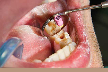 BClinic - Dental Clinic - Services - Microscopic Root Canal Treatment